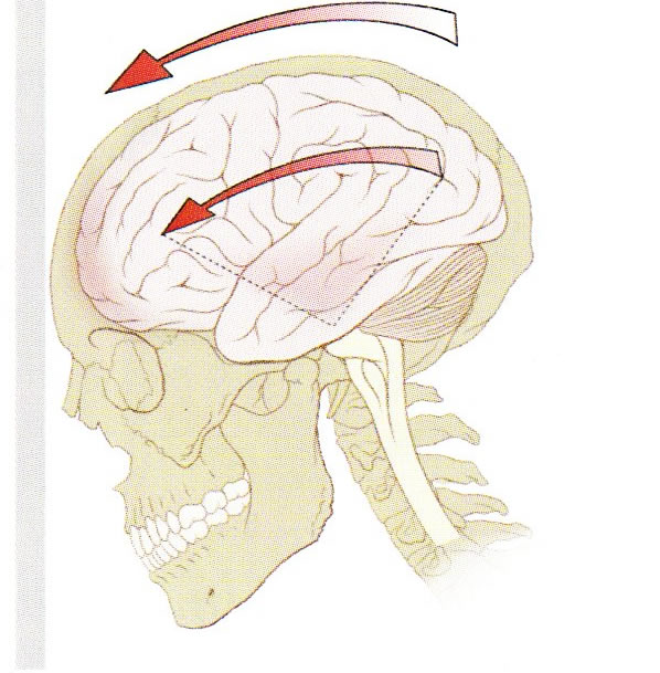 Countywide Concussion Care Update – Ransom Everglades Dell & Cannon April, 2011