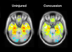 Advanced Brain Scanning Technique Reveals the Potentially Long-Lasting Effects of Concussions | National Institute of Neurological Disorders and Stroke