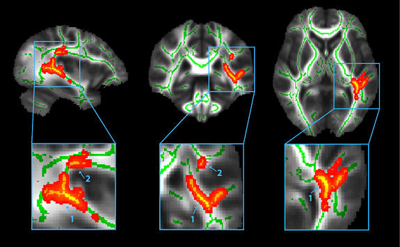 Concussion research aims to help athletes, study of the brain  – Princeton University