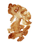 Images of Brain Injuries in Athletes